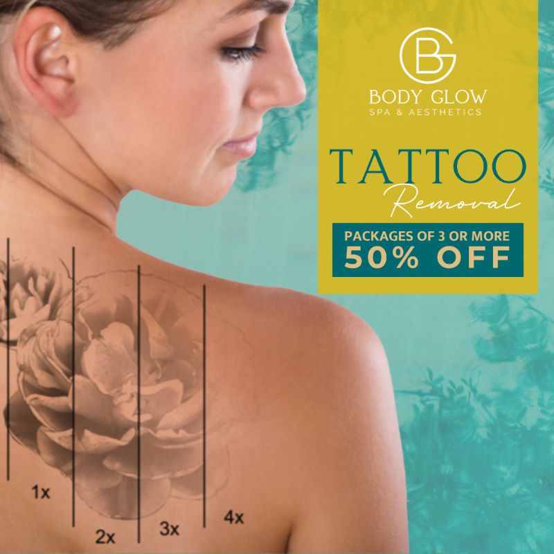 Tattoo Removal