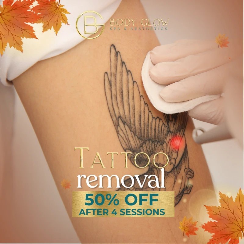 Tattoo Removal