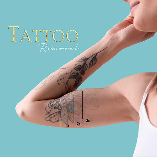 Tattoo Removal in Queens