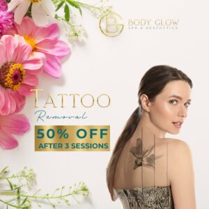 Tatto Removal - Mothers Sale
