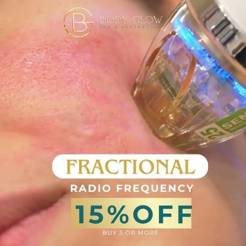 Fractional Rediofrequency Sale