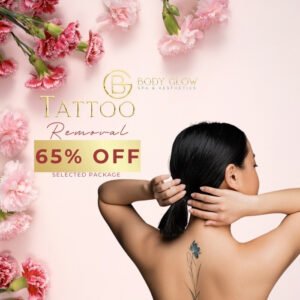 Tattoo Removal
