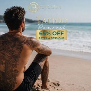 Tattoo Removal