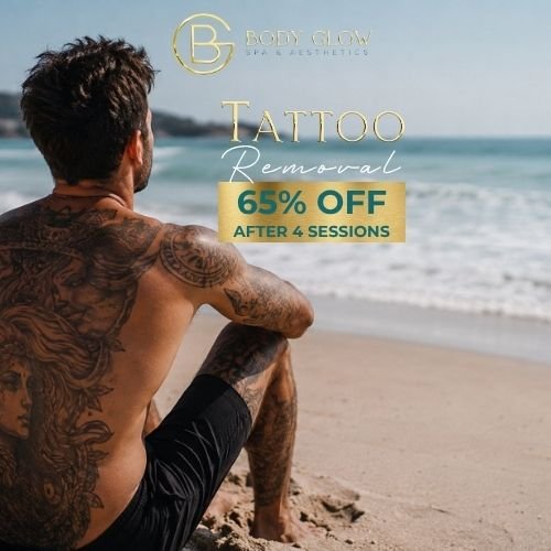 Tattoo Removal
