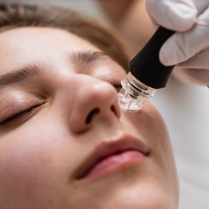Microneedling in Queens