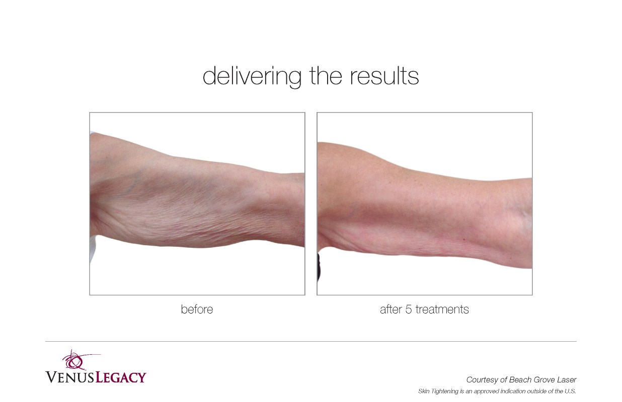 Before and After Venus Legacy