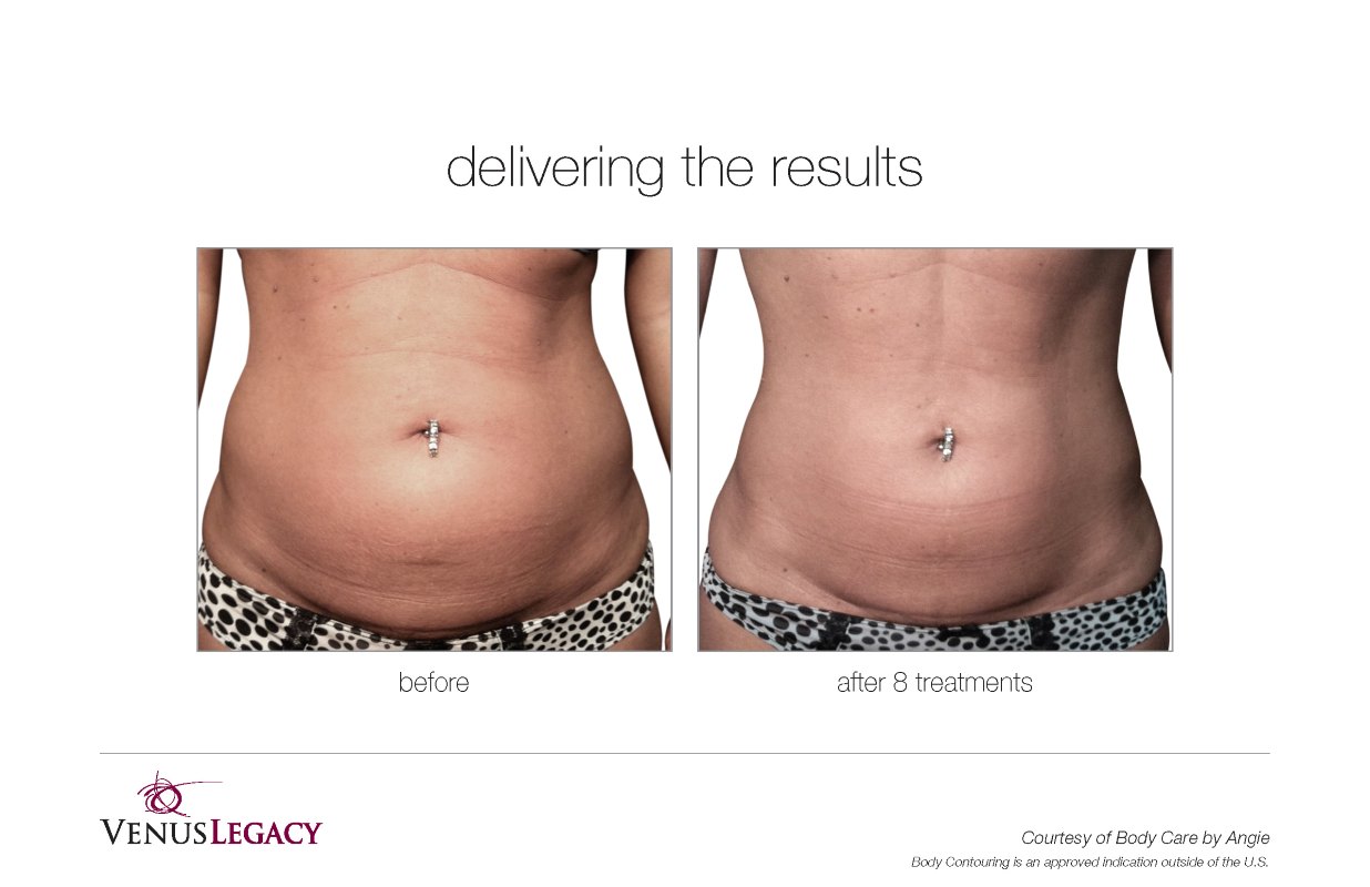 Before and After Venus Legacy