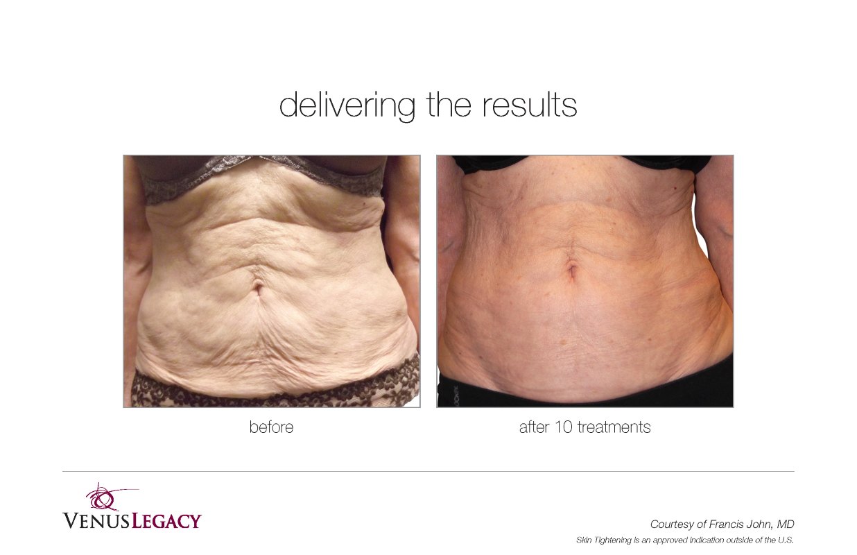 Before and After Venus Legacy