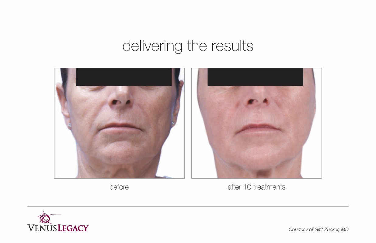 Before and After Venus Legacy