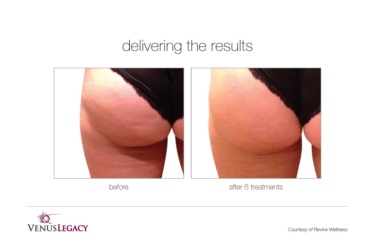 Before and After Venus Legacy