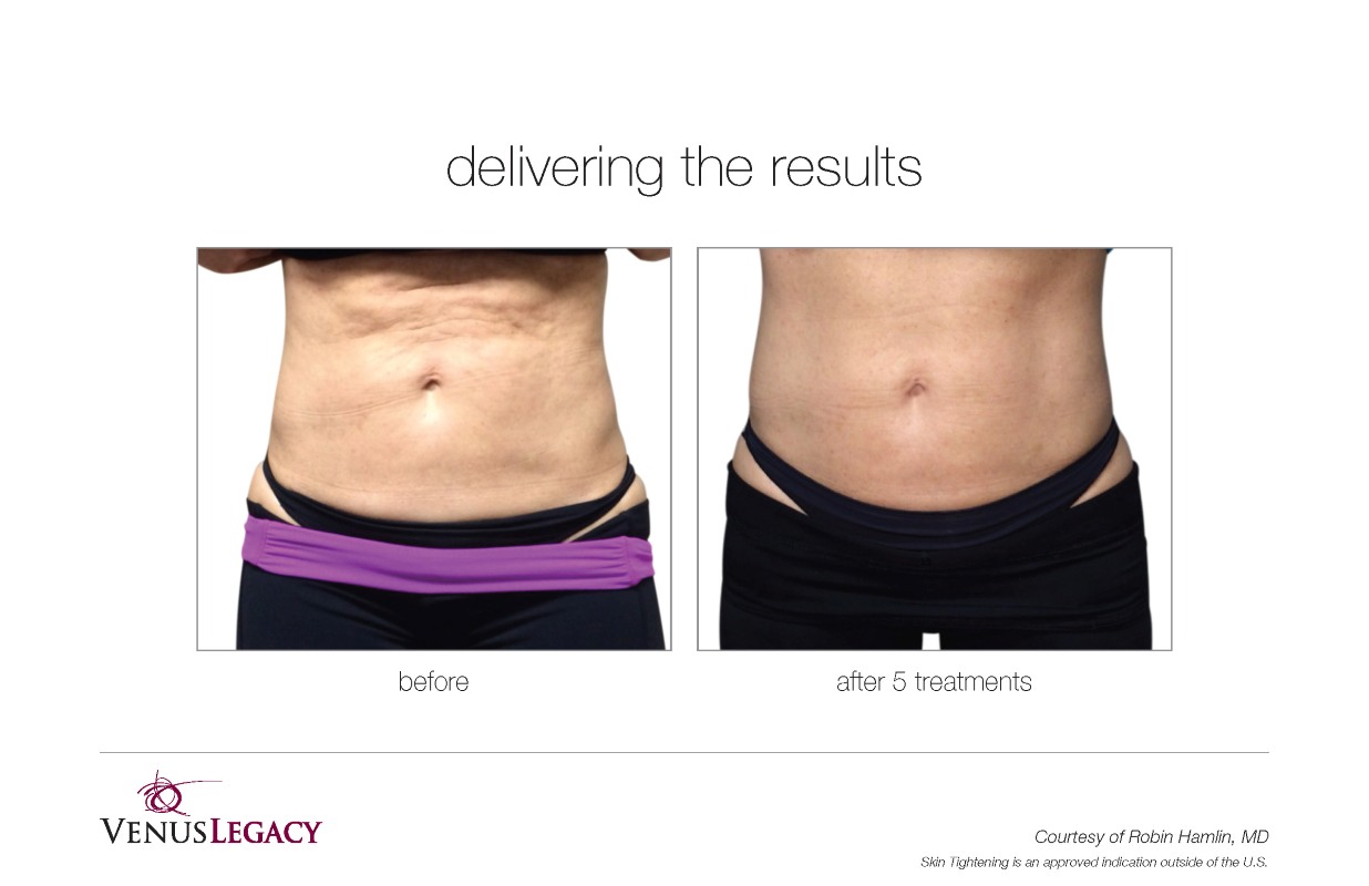 Before and After Venus Legacy