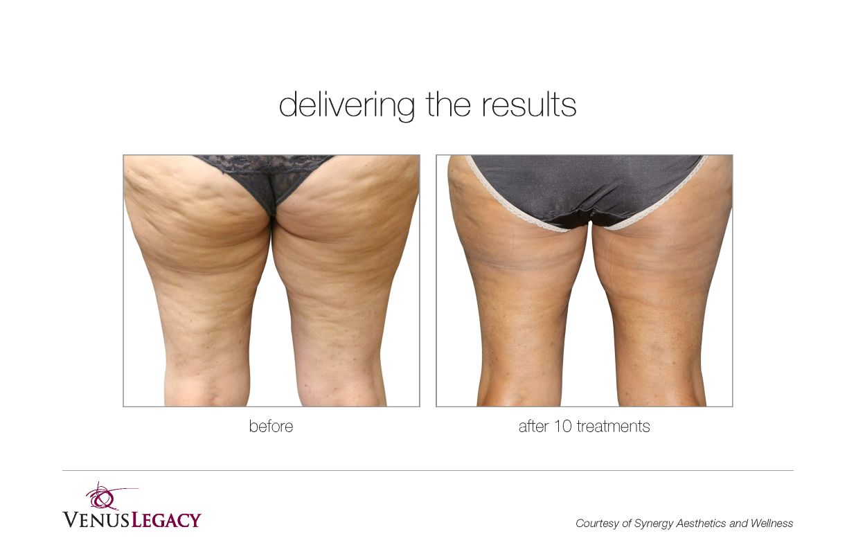 Before and After Venus Legacy