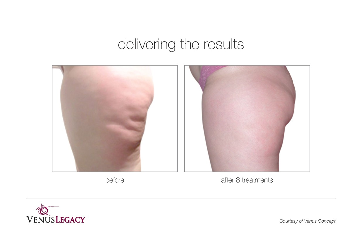 Before and After Venus Legacy