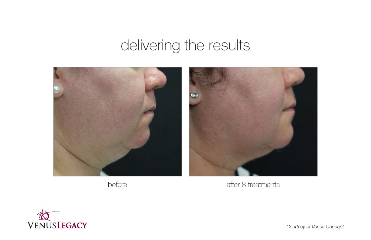 Before and After Venus Legacy