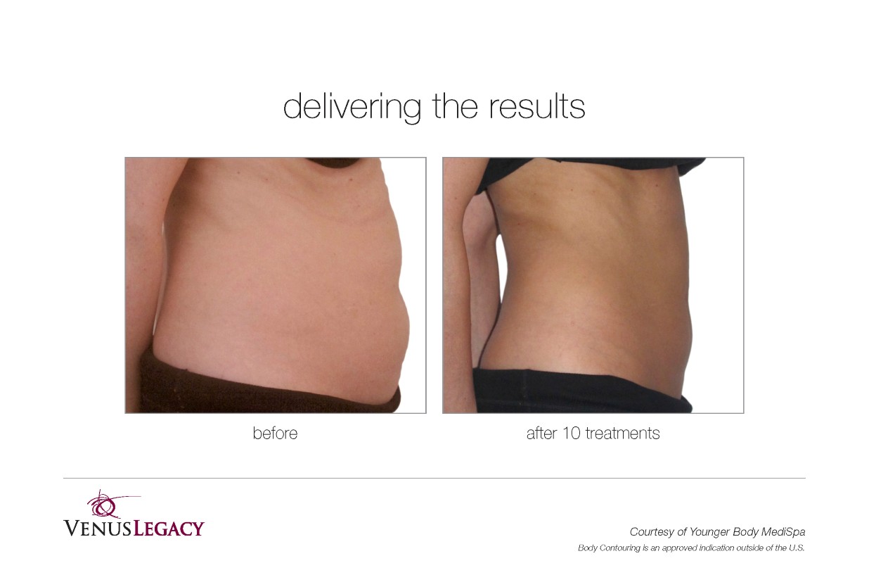 Before and After Venus Legacy