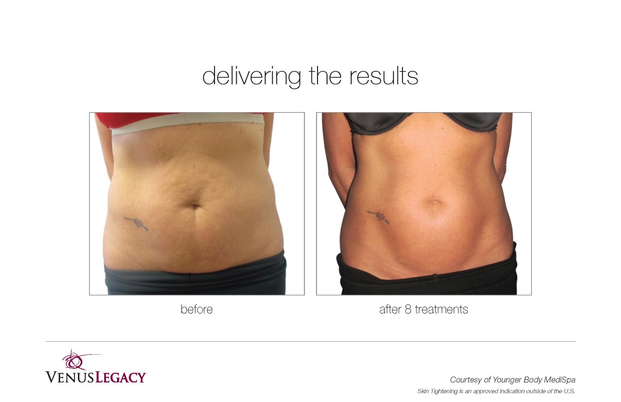 Before and After Venus Legacy