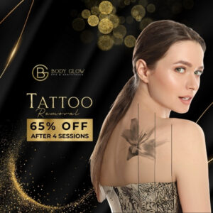 Tattoo Removal