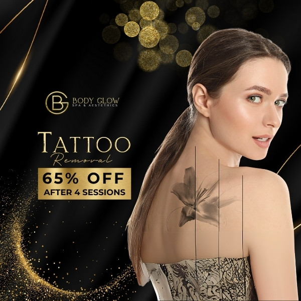 Tattoo Removal