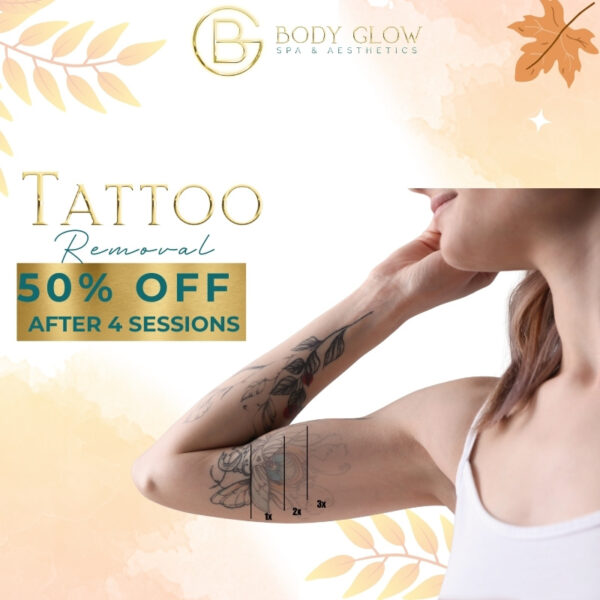 Tattoo Removal