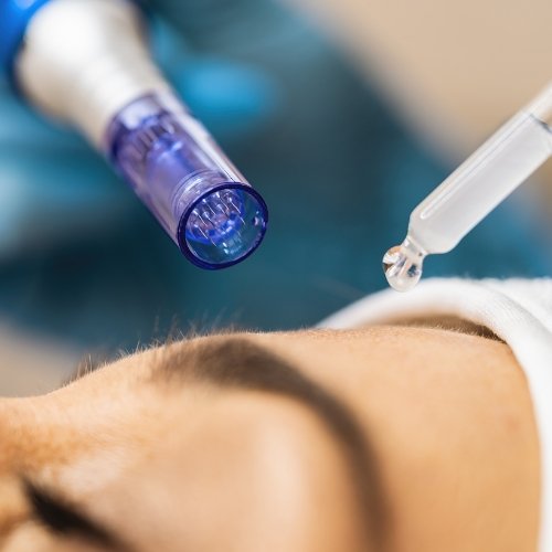 Exosome Microneedling Queens 2