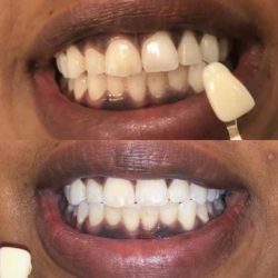 Teeth  Whitening